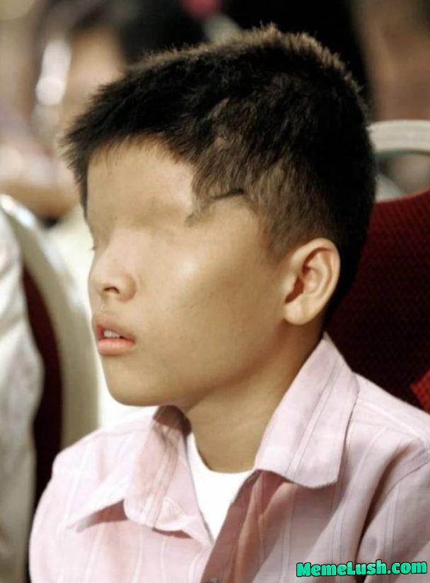 A 14 year old Vietnamese boy who was born without eyes because of the effects of Agent Orange