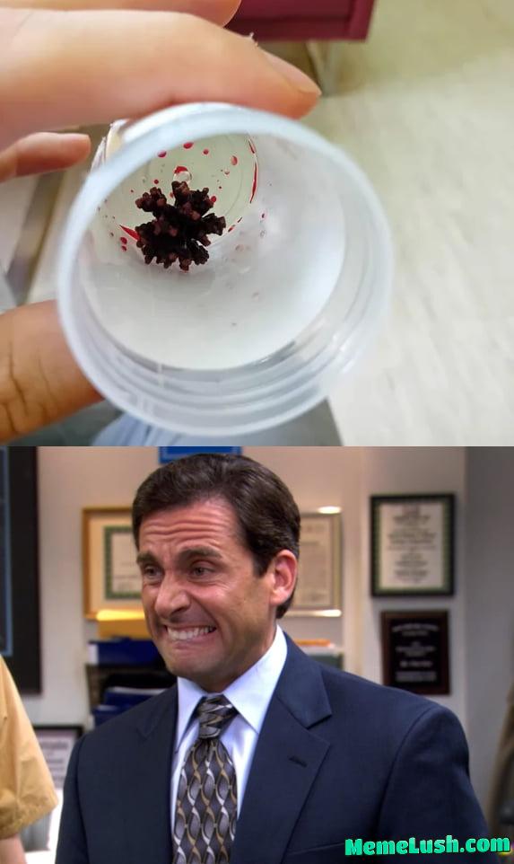 This is a big kidney stone This is a big kidney stone