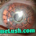 Artificial cornea implanted in a patient’s eye