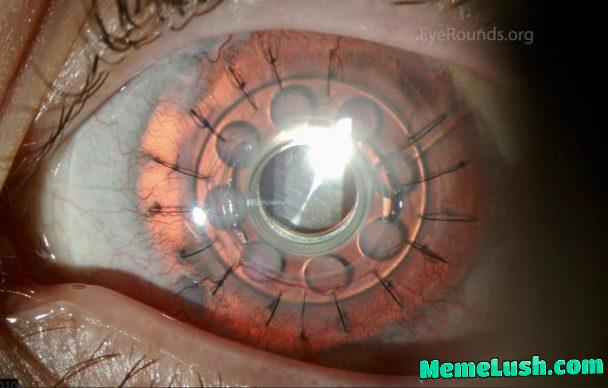 Artificial cornea implanted in a patient’s eye Artificial cornea implanted in a patient’s eye